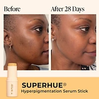 Superhue® Hyperpigmentation Serum Stick