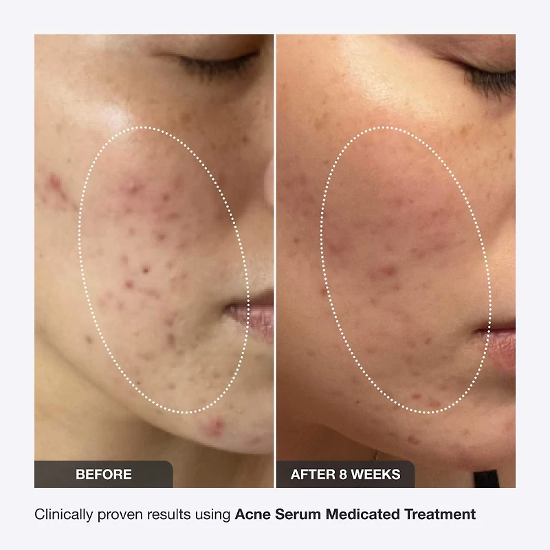 Acne Serum Medicated Treatment for Acne & Blackheads
