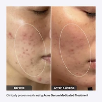 Acne Serum Medicated Treatment for Acne & Blackheads