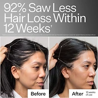 3% Stem Cell Peptide Hair + Scalp Treatment For Severe Hair Thinning