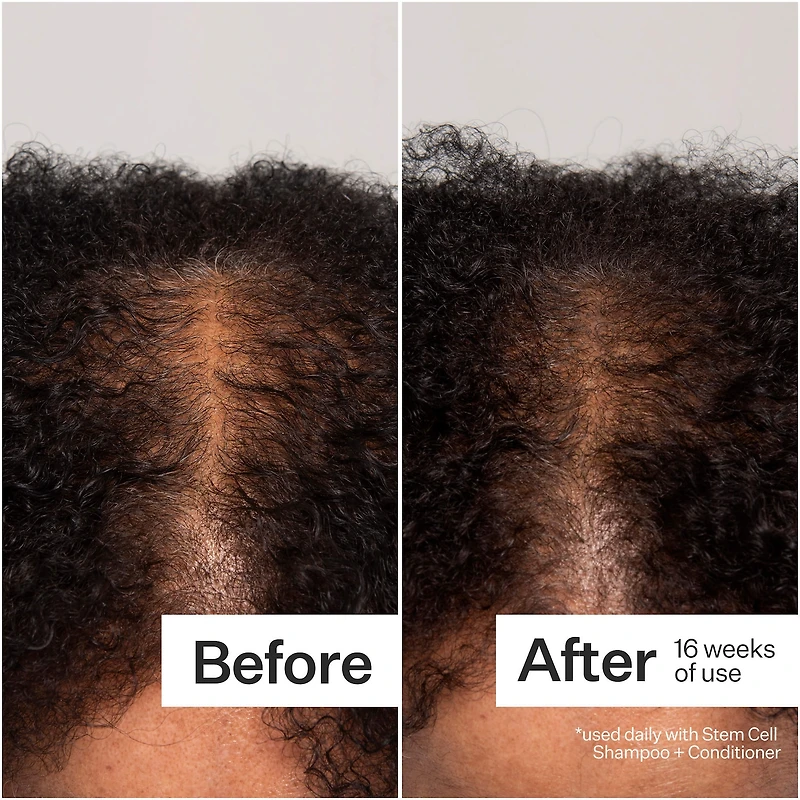 3% Stem Cell Peptide Hair + Scalp Treatment For Severe Hair Thinning