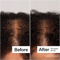 3% Stem Cell Peptide Hair + Scalp Treatment For Severe Hair Thinning