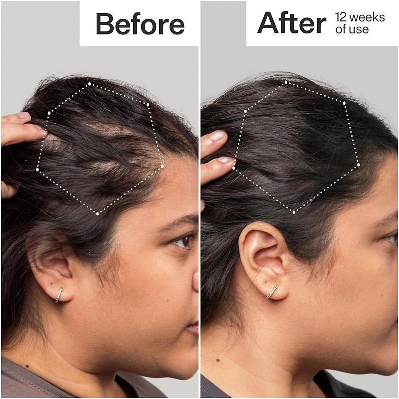 3% Stem Cell Peptide Hair + Scalp Treatment For Severe Hair Thinning