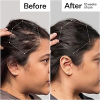 3% Stem Cell Peptide Hair + Scalp Treatment For Severe Hair Thinning