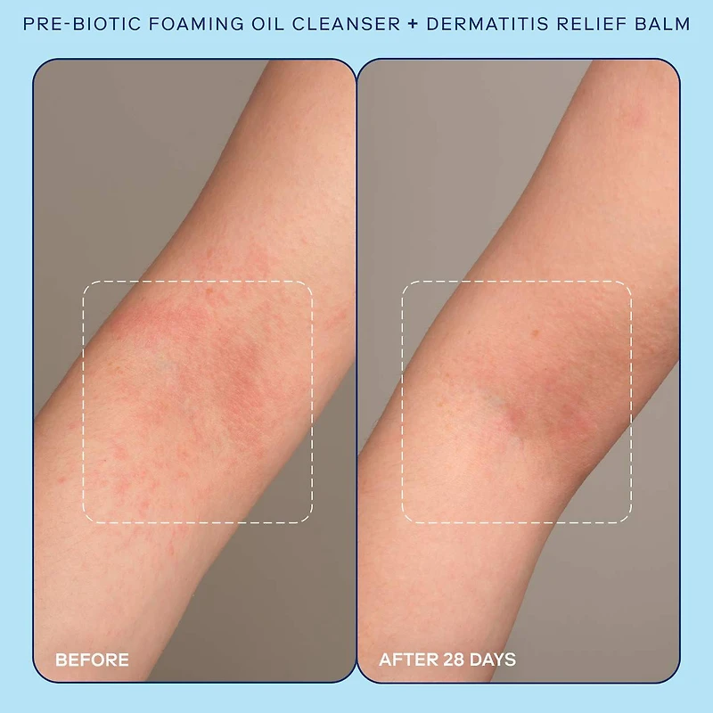 Huile moussante nettoyante au prébiotique Eczéma+