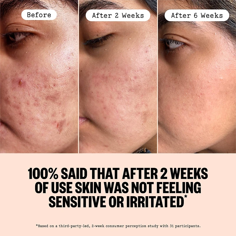 2% Salicylic Acid Daily Acne Treatment Serum