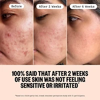 2% Salicylic Acid Daily Acne Treatment Serum