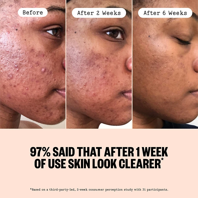 2% Salicylic Acid Daily Acne Treatment Serum