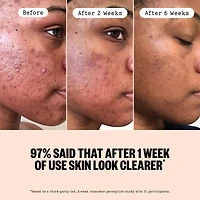 2% Salicylic Acid Daily Acne Treatment Serum