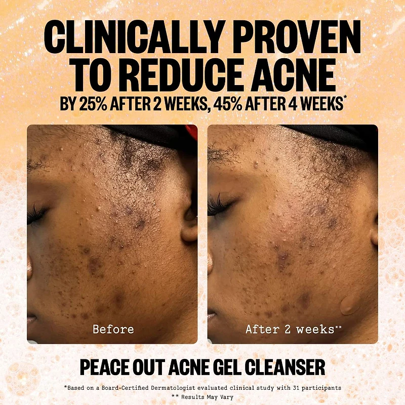 2% Salicylic Acid Acne Gel Cleanser
