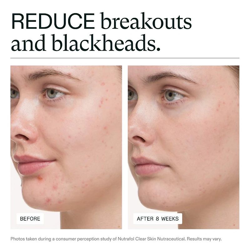 Clear Skin Physician-formulated Supplement for Acne and Breakouts