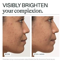 Clear Skin Physician-formulated Supplement for Acne and Breakouts
