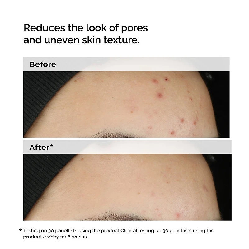 Balancing & Clarifying Serum for Oily Skin and Pore Refinement