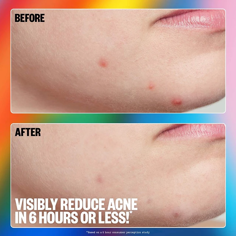 Salicylic Acid Acne Healing Dots
