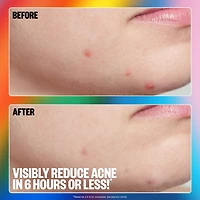 Salicylic Acid Acne Healing Dots