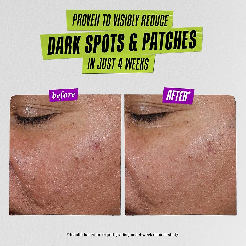 Auto-Tone Skin Discoloration Treatment with SPF 30