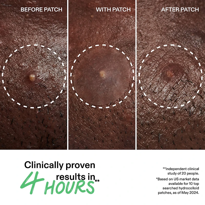 Hydrocolloid Invisible Pimple Patches + Salicylic Acid