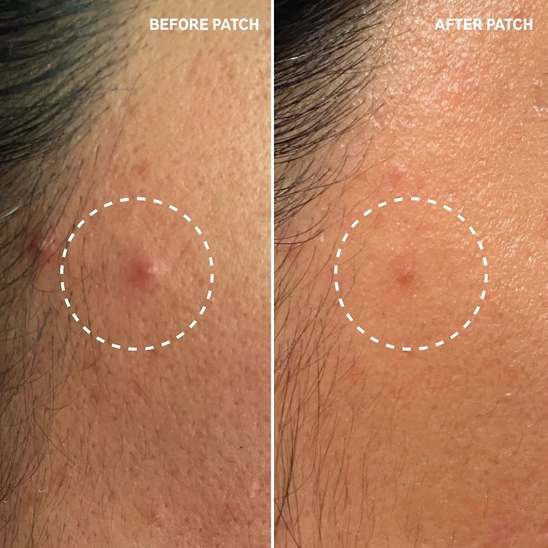 Hydrocolloid Invisible Pimple Patches + Salicylic Acid