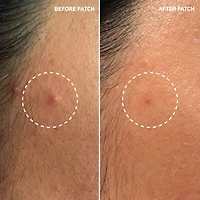 Hydrocolloid Invisible Pimple Patches + Salicylic Acid