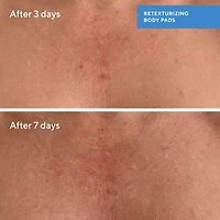 Retexturizing Body Pads with Salicylic Acid