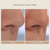Mini Triple Acid Signature Peel