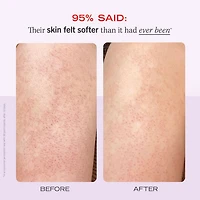 Exfoliant pour le corps KP Bump Eraser avec 10 % d’AHA cibler la kératose pilaire