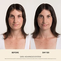 GRO+ Advanced Balancing Shampoo for Severe Signs of Thinning