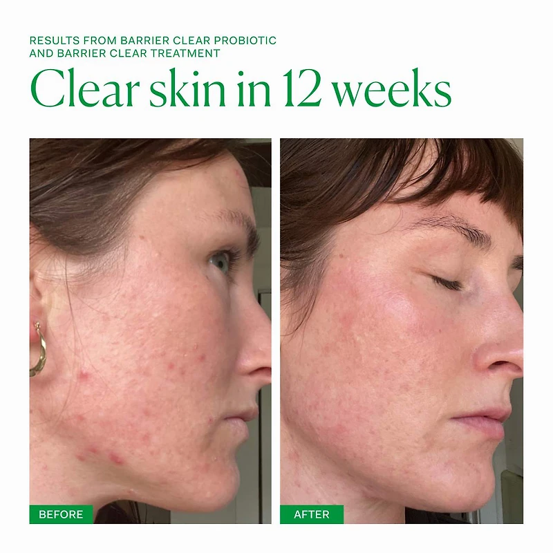 Barrier Clear Blemish Treatment