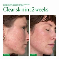 Barrier Clear Blemish Treatment