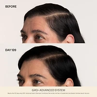 Sérum GRO+ Advanced pour cheveux très clairsemés