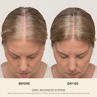 GRO+ Advanced Hair Serum for Severe Signs of Thinning
