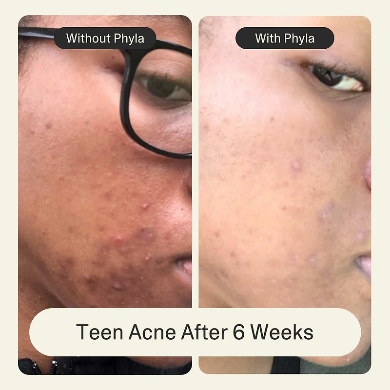 Acne Phage Serum