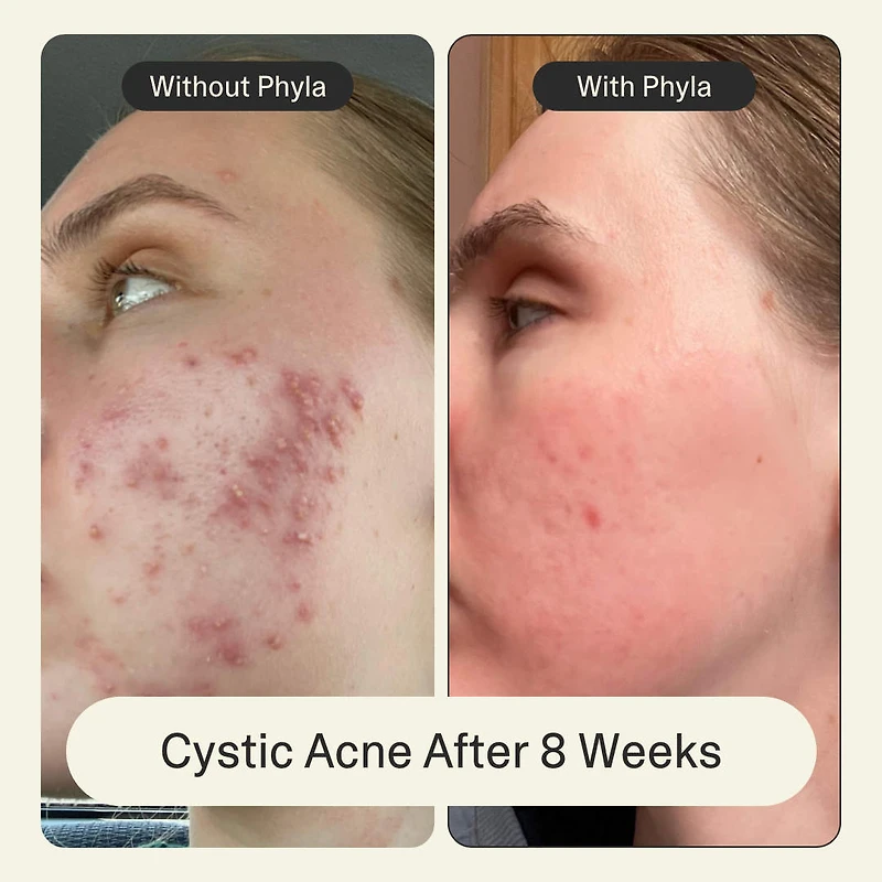 Acne Phage Serum