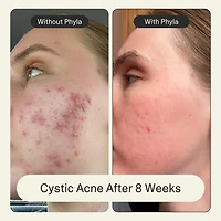 Acne Phage Serum