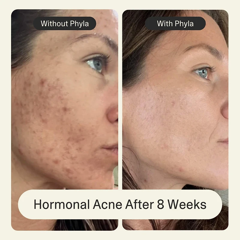 Acne Phage Serum