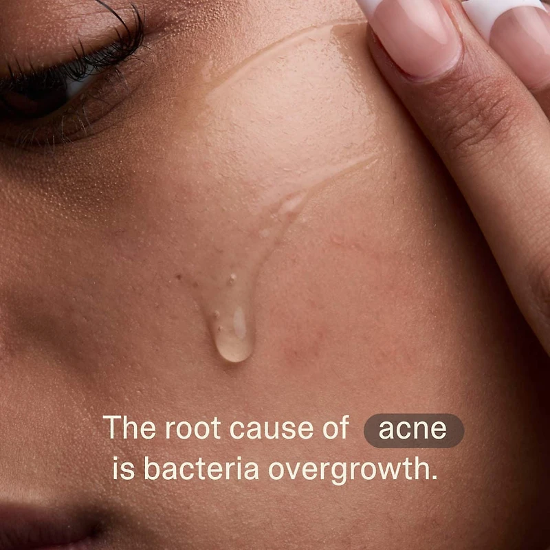 Acne Phage Serum
