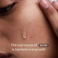 Acne Phage Serum