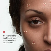 Acne Phage Serum