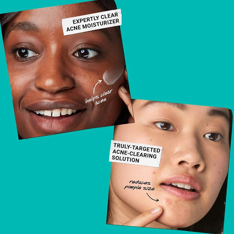 Ditch The Zituation Gift Set for Acne-Prone Skin
