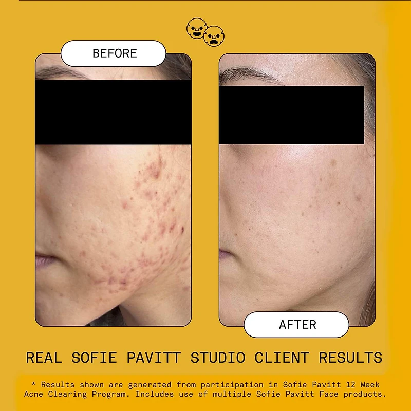 5% Benzoyl Peroxide Acne Treatment Mask with Glycolic Acid