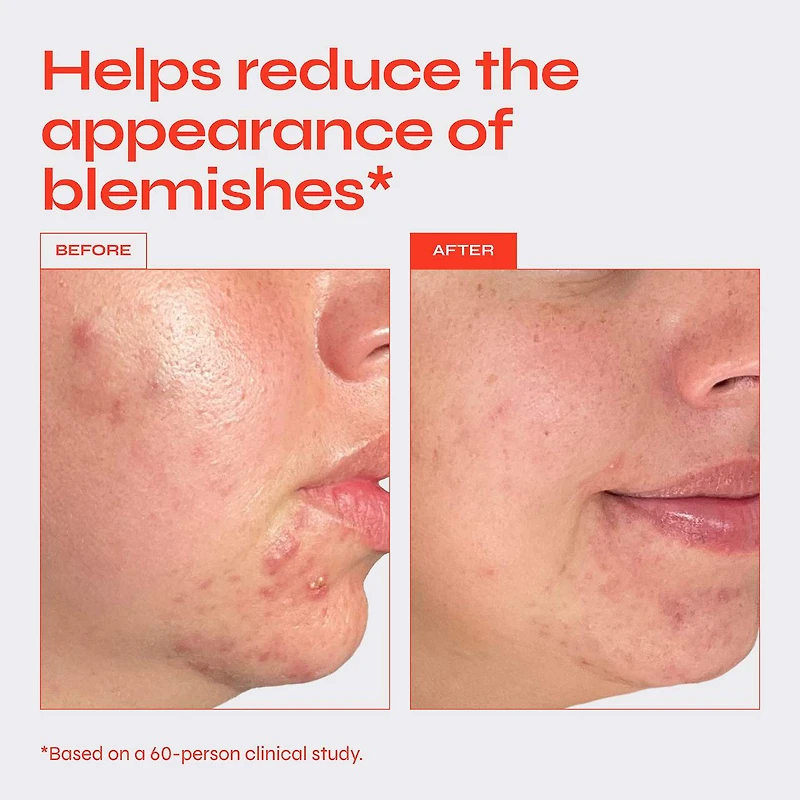 Clear Exfoliating Serum for Blemishes with 10% AHA + BHA Blend