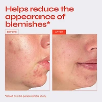 Clear Exfoliating Serum for Blemishes with 10% AHA + BHA Blend