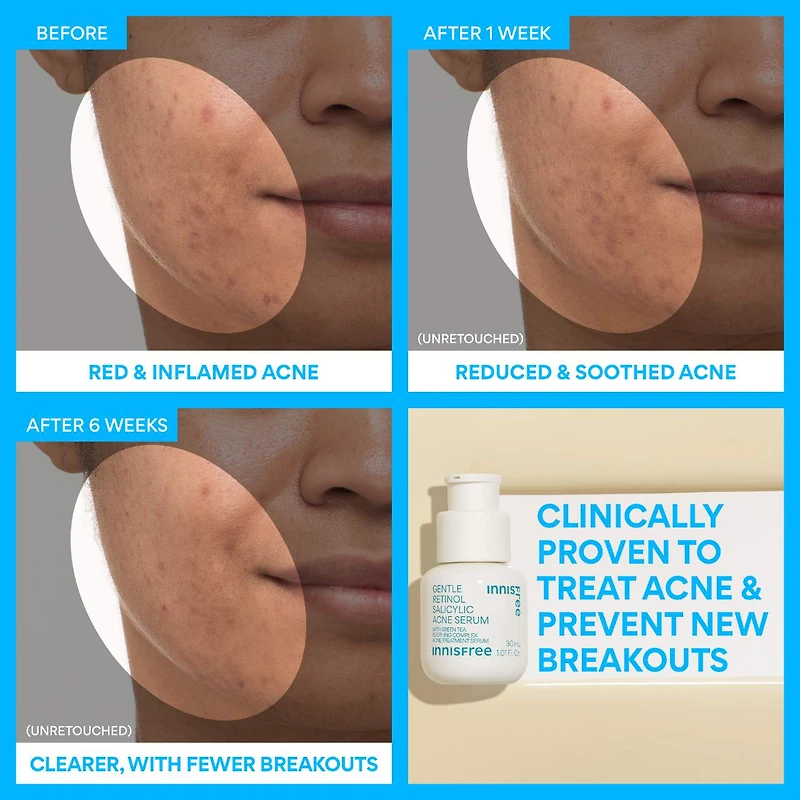 Gentle Retinol Salicylic Acne Serum