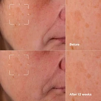 Even Better Clinical™ Dark Spot Clearing Serum with Vitamin C