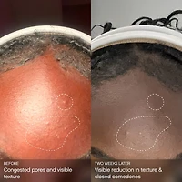 Clearly Clarifying & Calming Mist For Acne-Prone Skin