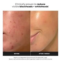 Lotion tonique exfoliante Skin Perfecting 2 % BHA pour une peau nette