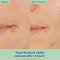 Vinopure Targeted Spot Solution with Salicylic Acid​