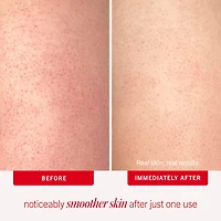 Exfoliant pour le corps KP Bump Eraser avec 10 % d’AHA cibler la kératose pilaire