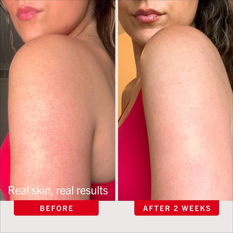 KP Bump Eraser Body Scrub with 10% AHA – Exfoliant for Keratosis Pilaris