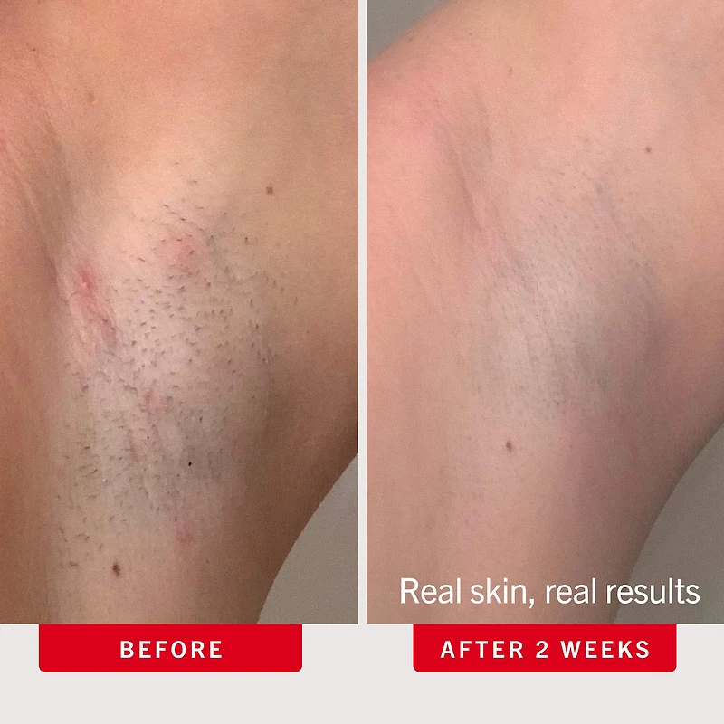 'Ingrown Hair Pads with AHA + BHA for Body + Face'